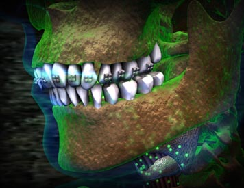 Braces Infection Atlanta Medical Animation